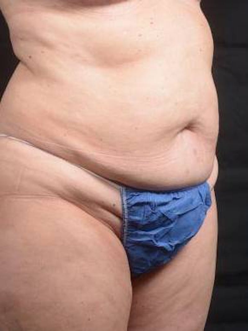 Abdominoplasty Before & After Gallery - Patient 296367 - Image 9