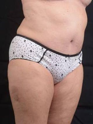 Abdominoplasty Before & After Gallery - Patient 296367 - Image 10