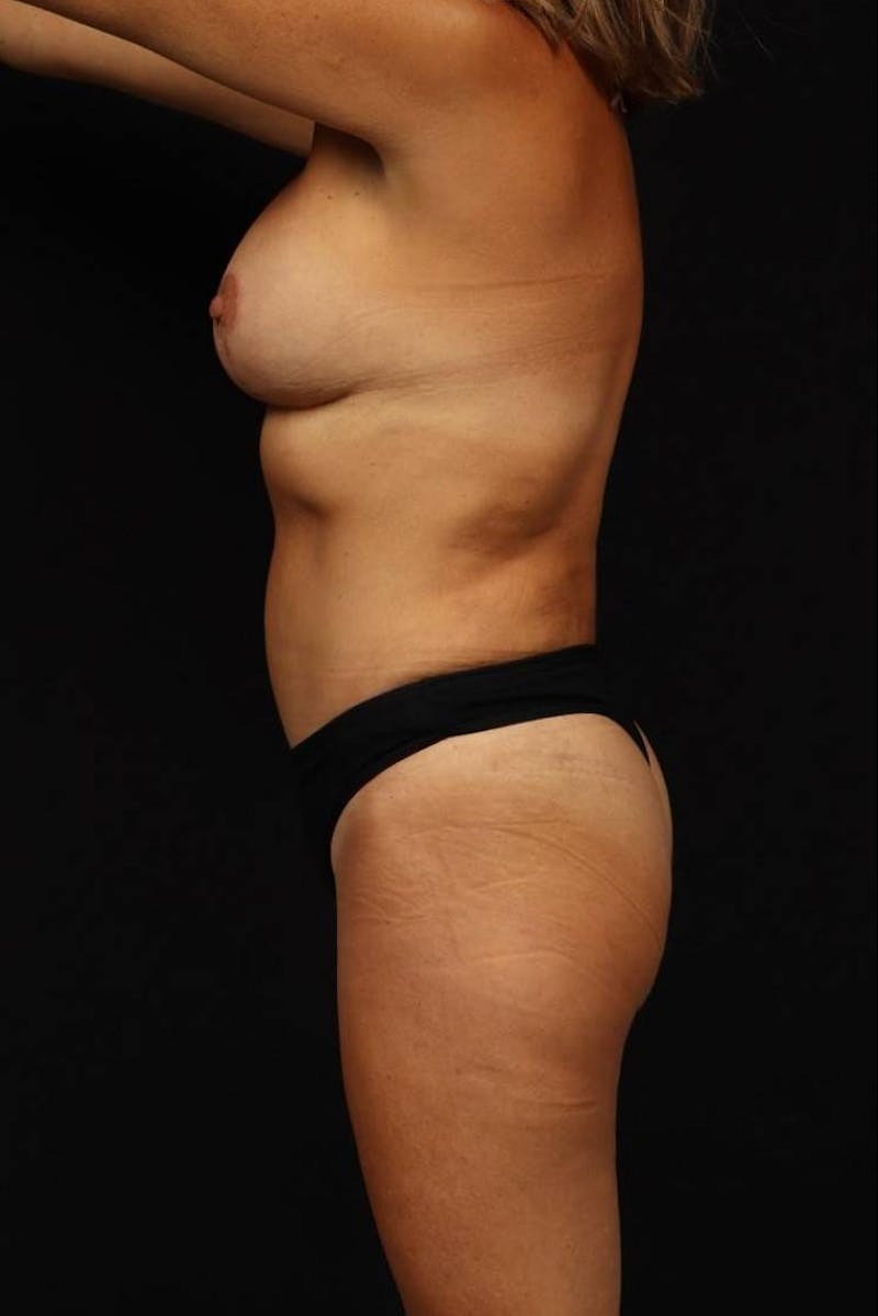 Aesthetic Breast Revision Before & After Gallery - Patient 317475 - Image 6