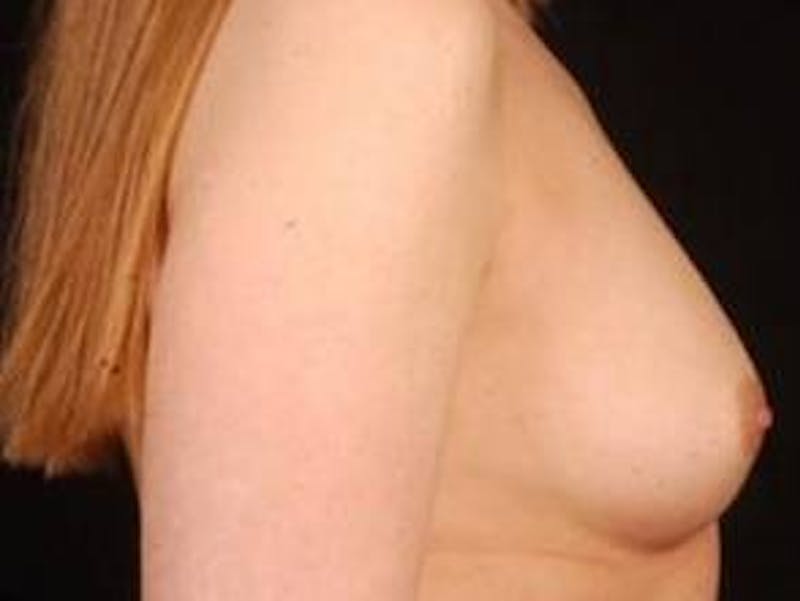 Breast Augmentation Silicone Gel Before & After Gallery - Patient 576779 - Image 5
