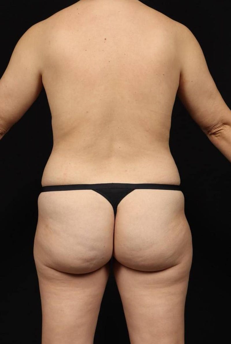 Mommy Makeover Before & After Gallery - Patient 232047 - Image 11