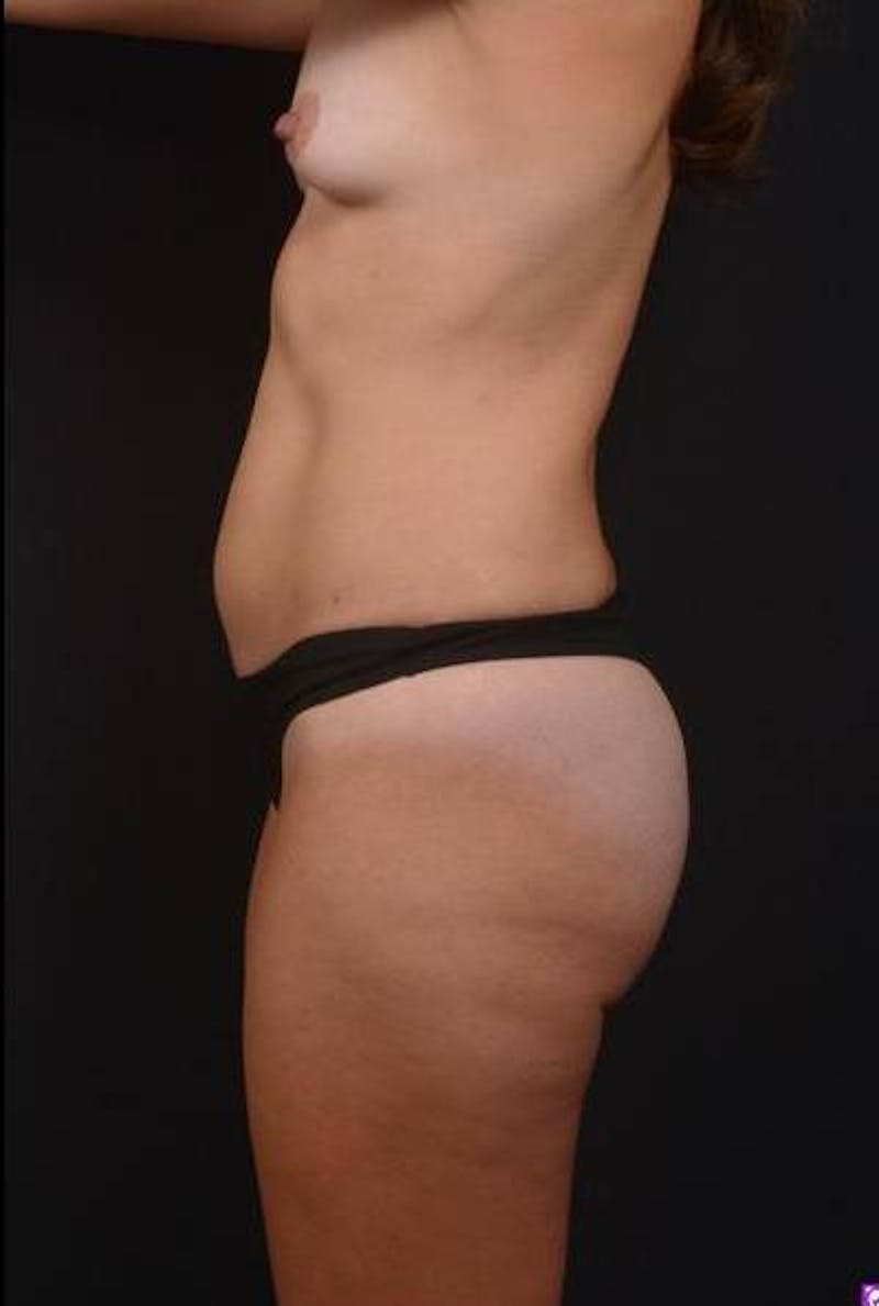 Abdominoplasty Before & After Gallery - Patient 115195 - Image 5
