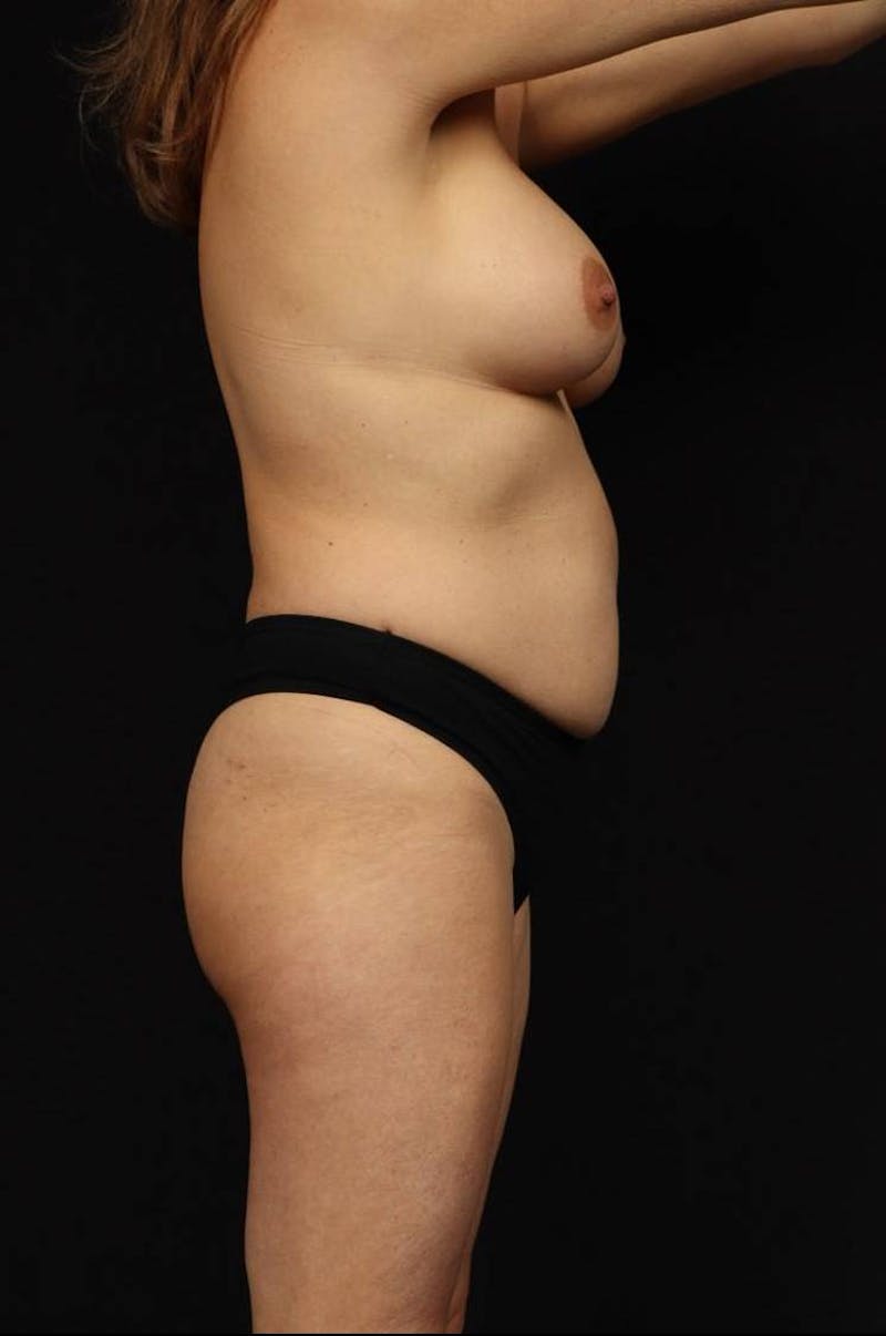 Aesthetic Breast Revision Before & After Gallery - Patient 317475 - Image 9