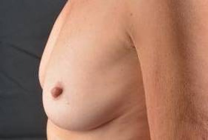 Breast Augmentation Silicone Gel Before & After Gallery - Patient 272818 - Image 3