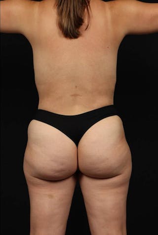 Mommy Makeover Before & After Gallery - Patient 232047 - Image 12