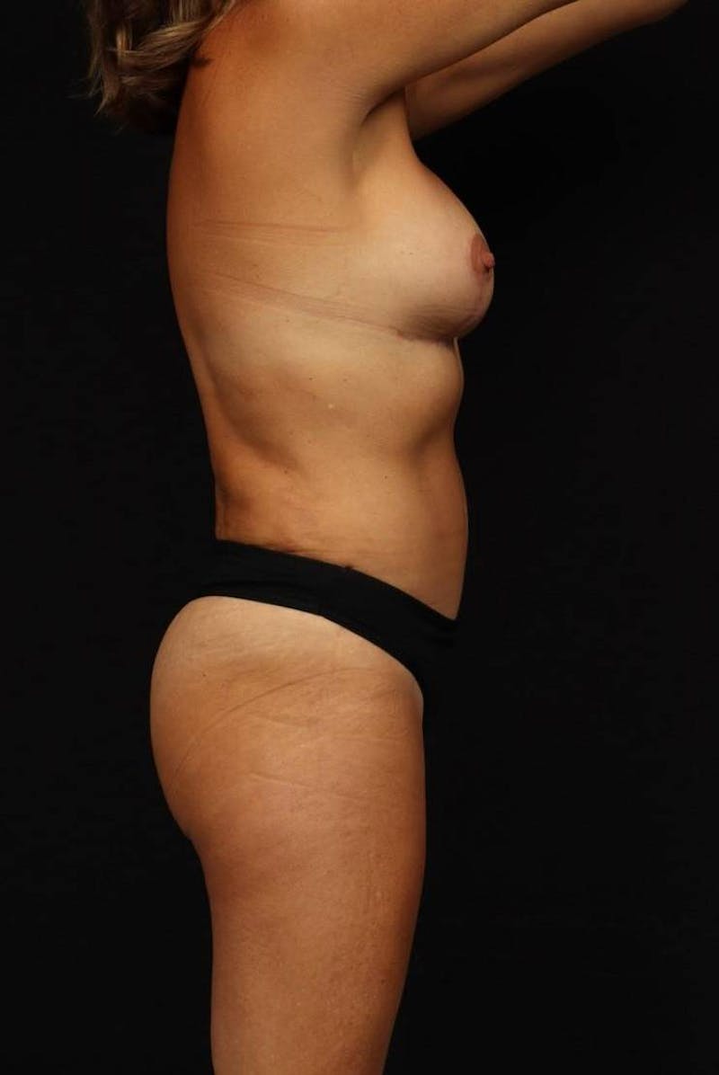 Aesthetic Breast Revision Before & After Gallery - Patient 317475 - Image 10