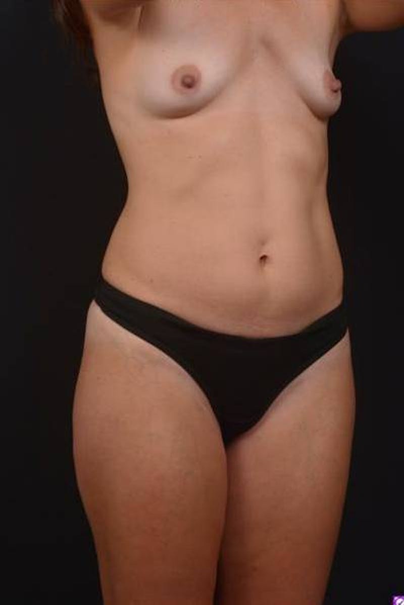 Abdominoplasty Before & After Gallery - Patient 115195 - Image 7