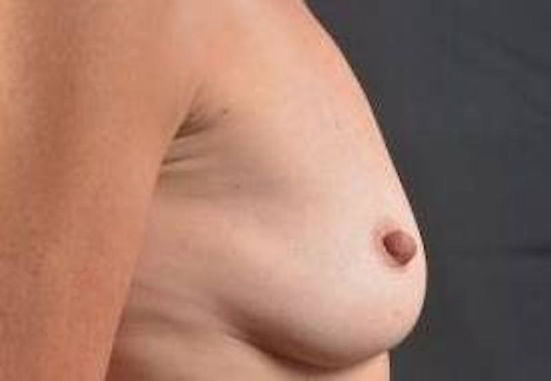 Breast Augmentation Silicone Gel Before & After Gallery - Patient 272818 - Image 5