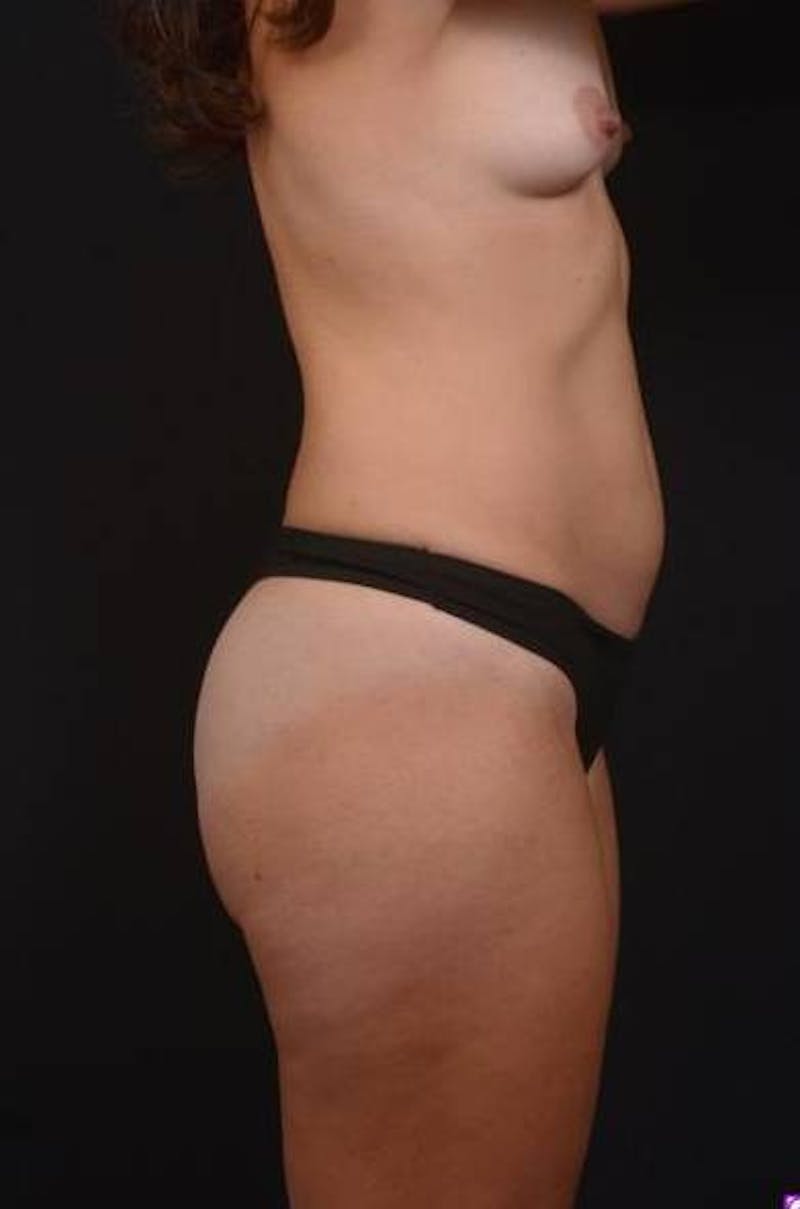Abdominoplasty Before & After Gallery - Patient 115195 - Image 9