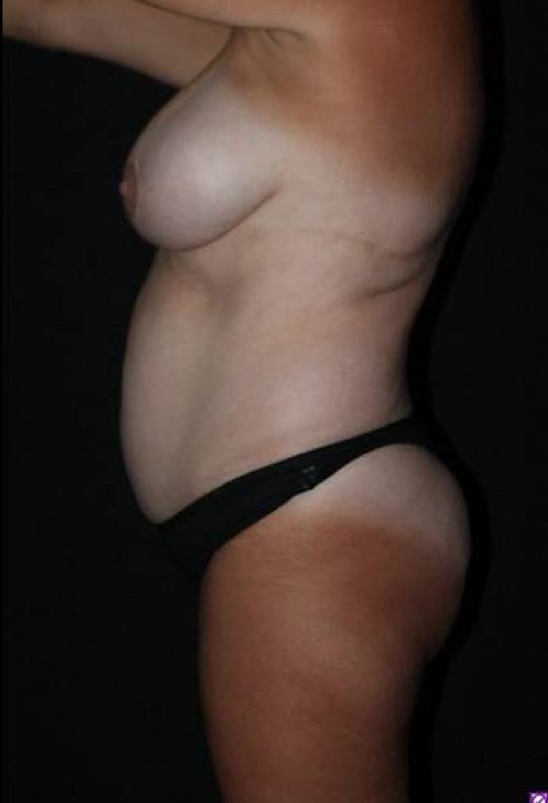 Abdominoplasty Before & After Gallery - Patient 399746 - Image 5