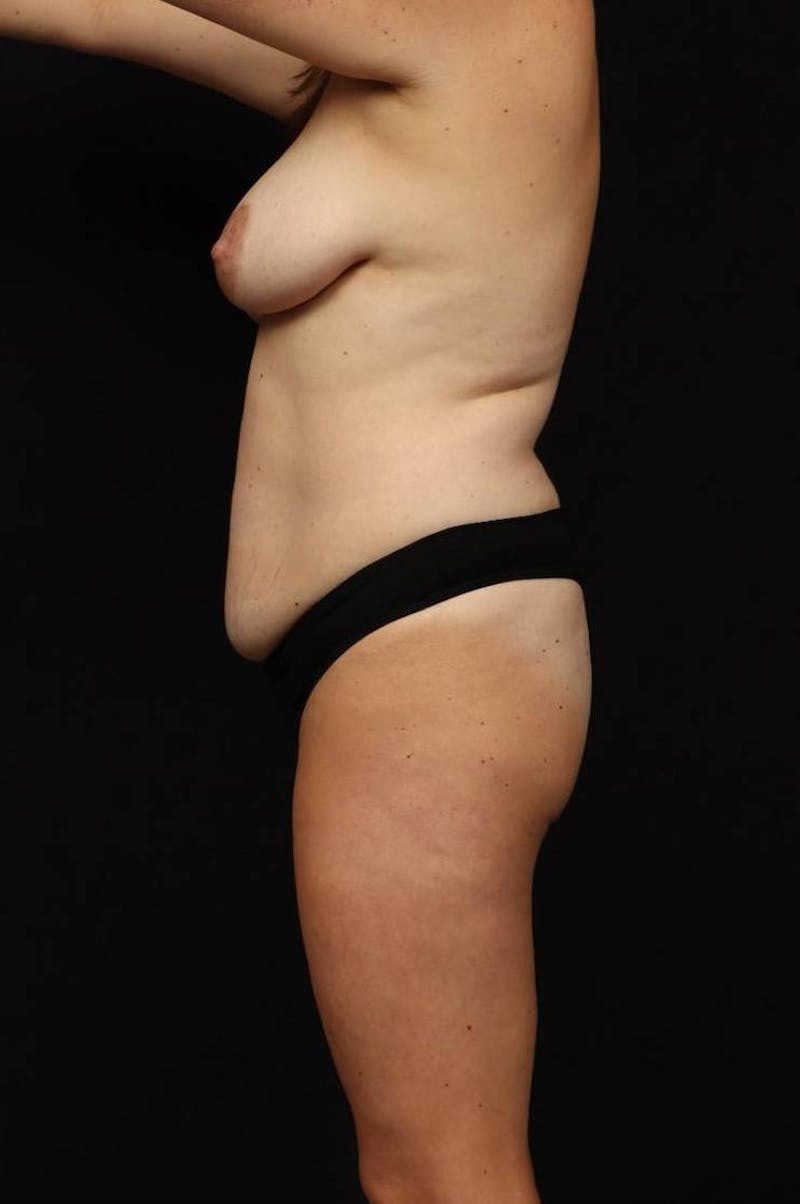 Mommy Makeover Before & After Gallery - Patient 167149 - Image 5