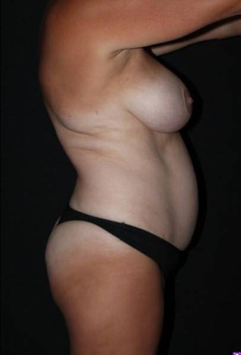 Abdominoplasty Before & After Gallery - Patient 399746 - Image 9