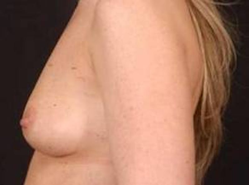 Breast Augmentation Silicone Gel Before & After Gallery - Patient 490916 - Image 3