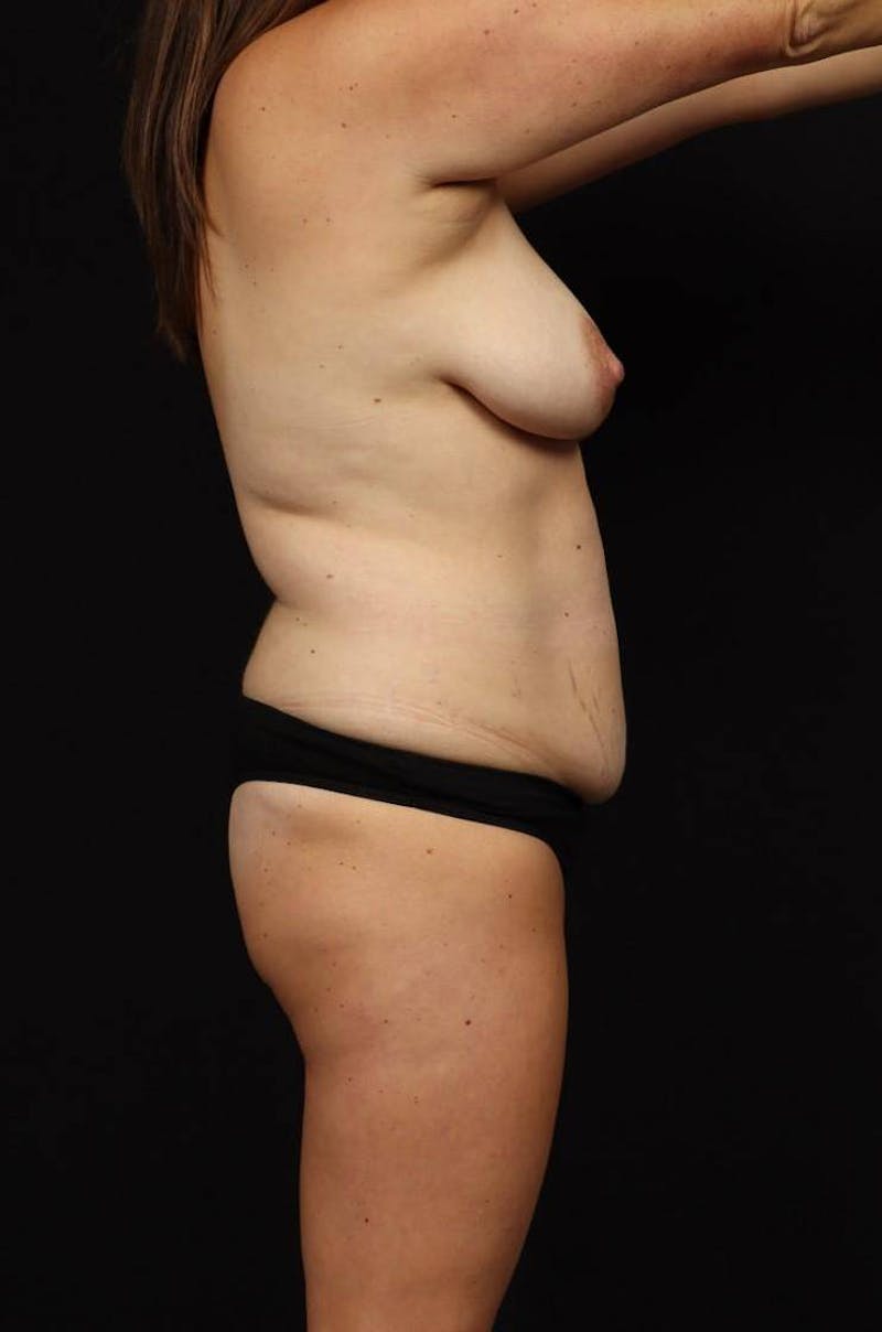 Mommy Makeover Before & After Gallery - Patient 167149 - Image 9