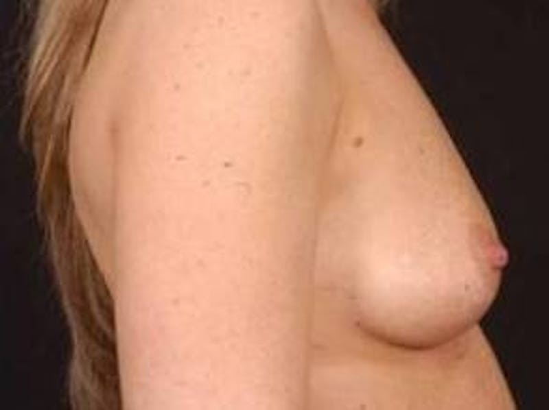 Breast Augmentation Silicone Gel Before & After Gallery - Patient 490916 - Image 5