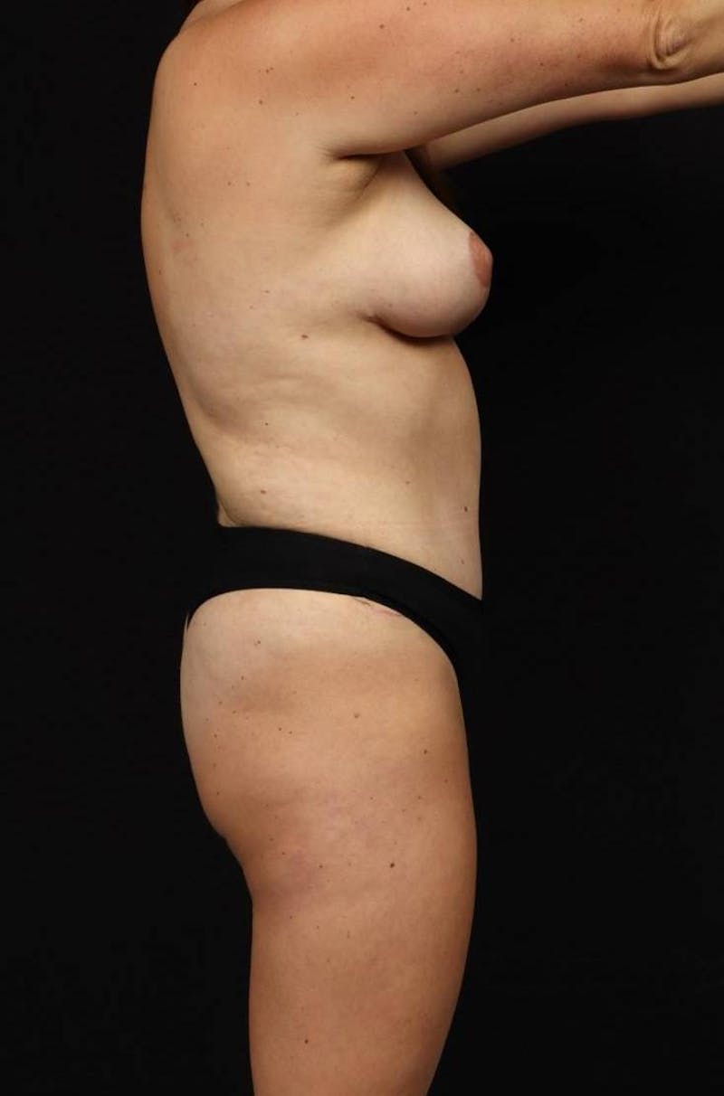 Mommy Makeover Before & After Gallery - Patient 167149 - Image 10