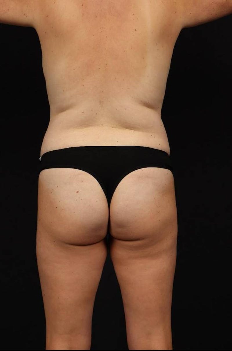 Mommy Makeover Before & After Gallery - Patient 167149 - Image 11