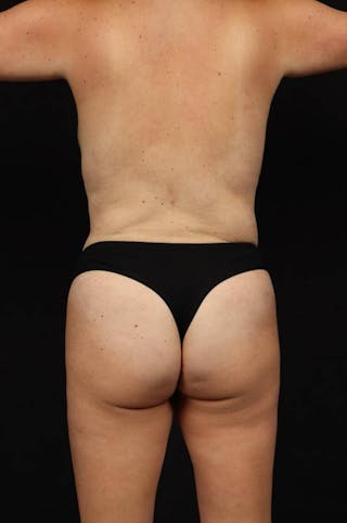 Mommy Makeover Before & After Gallery - Patient 167149 - Image 12