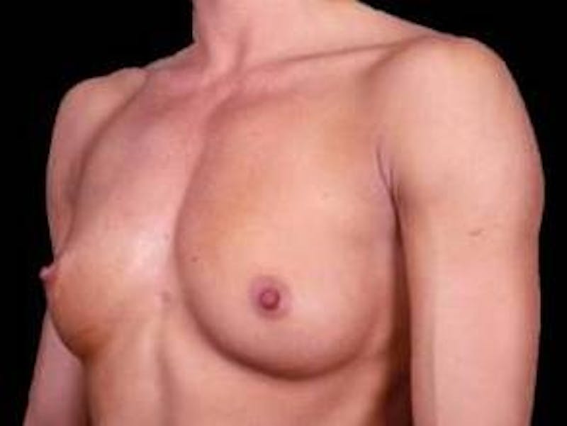 Breast Augmentation Silicone Gel Before & After Gallery - Patient 190938 - Image 3