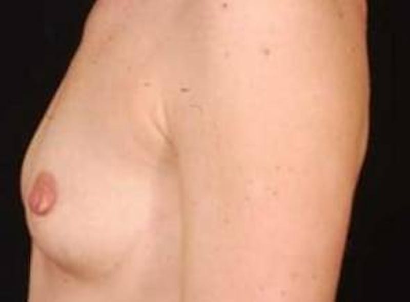 Breast Augmentation Silicone Gel Before & After Gallery - Patient 331851 - Image 3