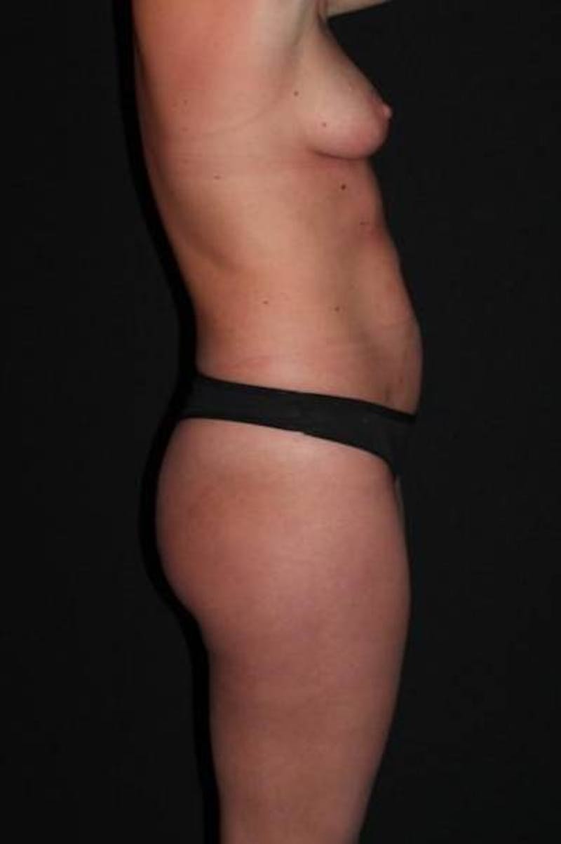 Abdominoplasty Before & After Gallery - Patient 145707 - Image 9