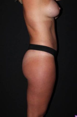Abdominoplasty Before & After Gallery - Patient 145707 - Image 10