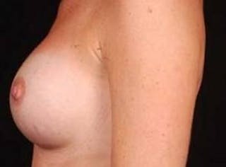 Breast Augmentation Silicone Gel Before & After Gallery - Patient 331851 - Image 4