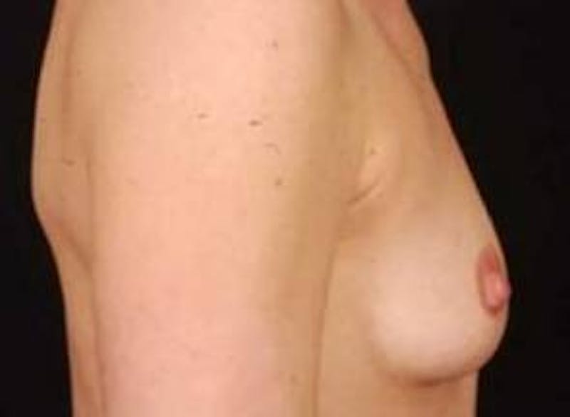 Breast Augmentation Silicone Gel Before & After Gallery - Patient 331851 - Image 5