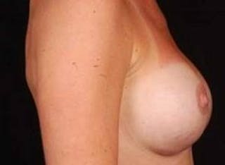 Breast Augmentation Silicone Gel Before & After Gallery - Patient 331851 - Image 6