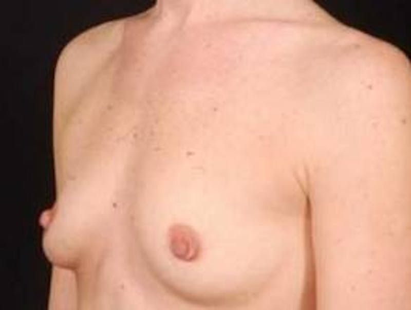 Breast Augmentation Silicone Gel Before & After Gallery - Patient 331851 - Image 7