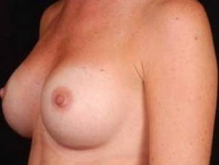 Breast Augmentation Silicone Gel Before & After Gallery - Patient 331851 - Image 8