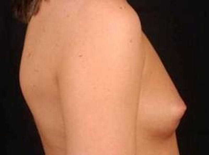 Breast Augmentation Silicone Gel Before & After Gallery - Patient 360509 - Image 5