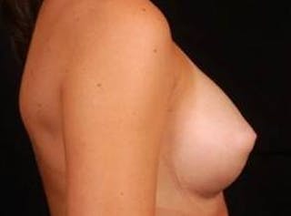 Breast Augmentation Silicone Gel Before & After Gallery - Patient 360509 - Image 6