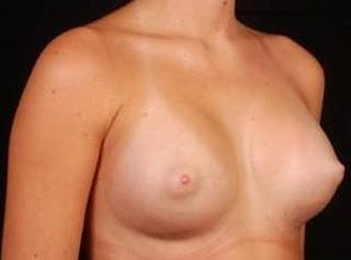 Breast Augmentation Silicone Gel Before & After Gallery - Patient 360509 - Image 8