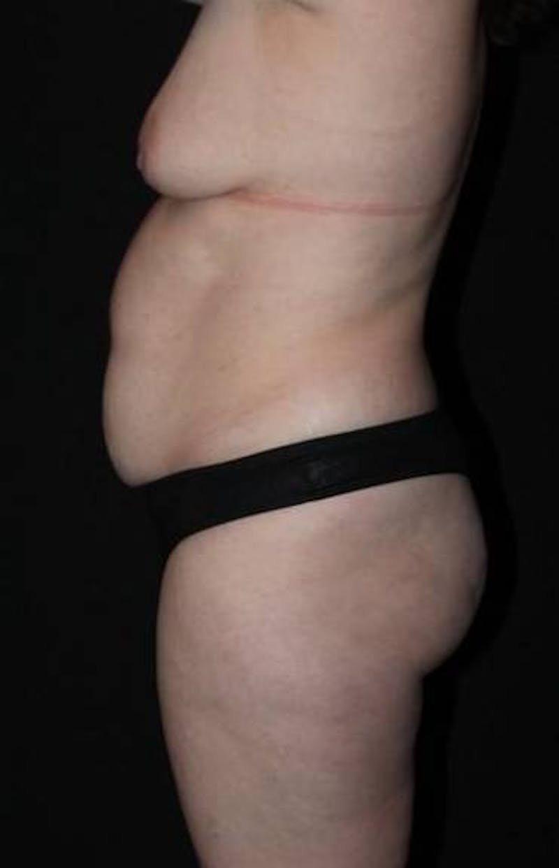 Abdominoplasty Before & After Gallery - Patient 194178 - Image 5