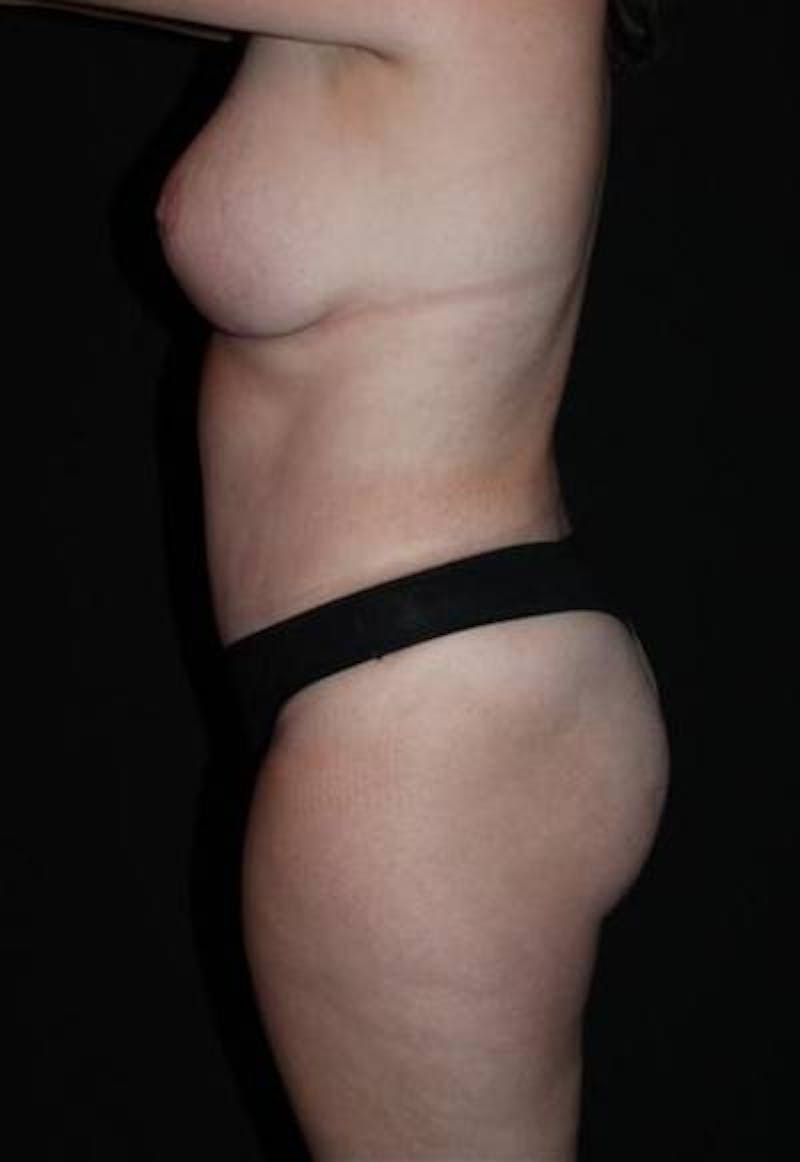 Abdominoplasty Before & After Gallery - Patient 194178 - Image 6