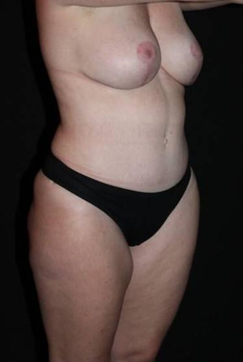 Abdominoplasty Before & After Gallery - Patient 194178 - Image 8