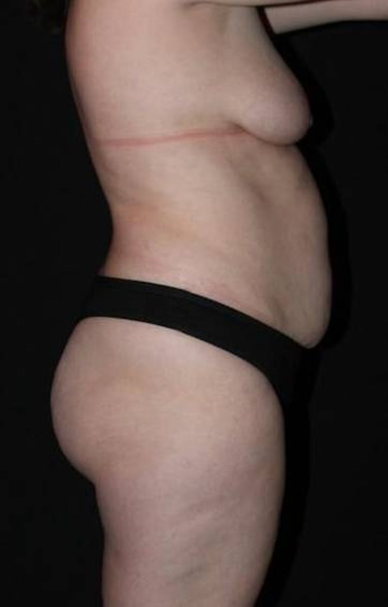 Abdominoplasty Before & After Gallery - Patient 194178 - Image 9