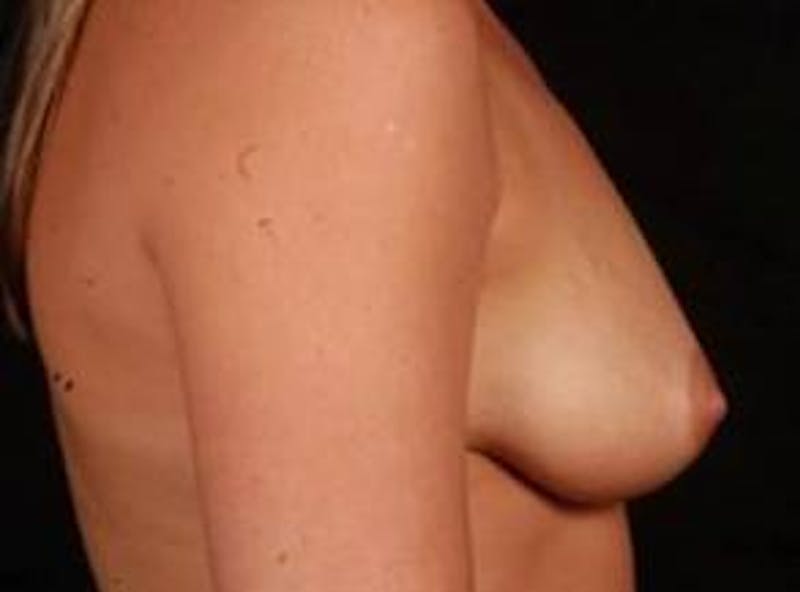 Breast Augmentation Silicone Gel Before & After Gallery - Patient 271932 - Image 5
