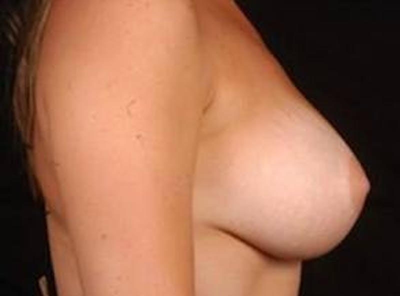 Breast Augmentation Silicone Gel Before & After Gallery - Patient 271932 - Image 6