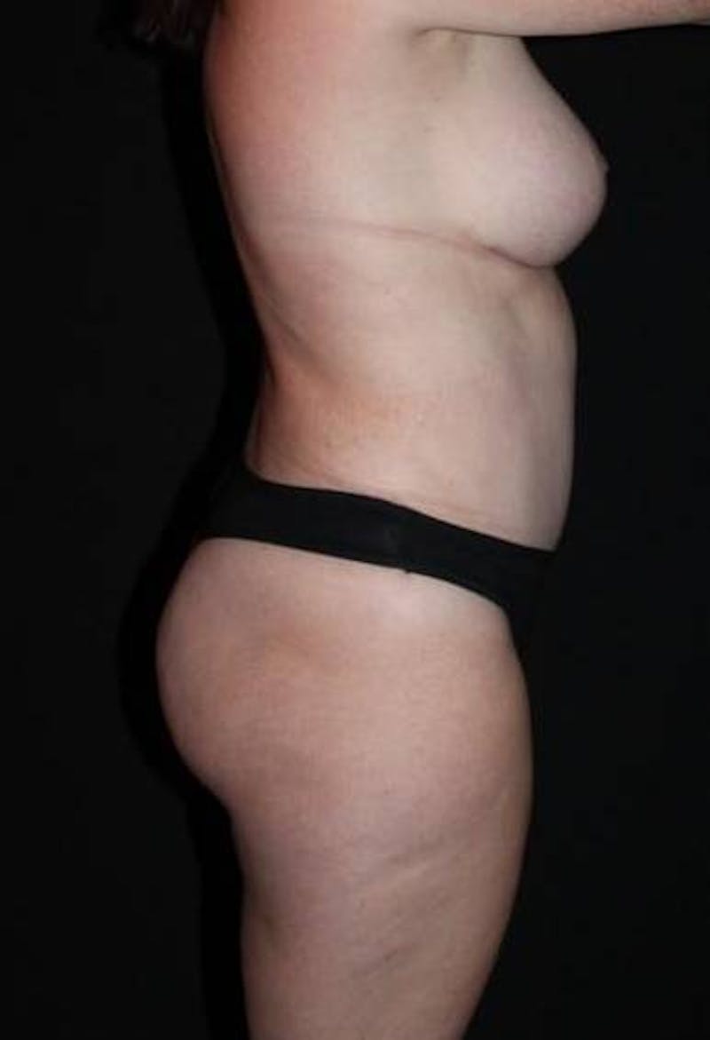 Abdominoplasty Before & After Gallery - Patient 194178 - Image 10