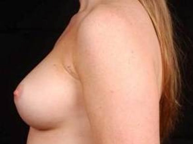 Breast Augmentation Silicone Gel Before & After Gallery - Patient 400833 - Image 3