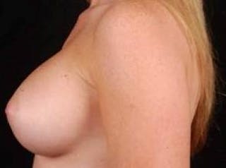 Breast Augmentation Silicone Gel Before & After Gallery - Patient 400833 - Image 4