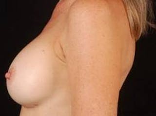 Breast Augmentation Silicone Gel Before & After Gallery - Patient 342893 - Image 4