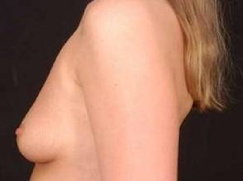 Breast Augmentation Silicone Gel Before & After Gallery - Patient 377391 - Image 3