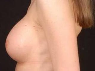 Breast Augmentation Silicone Gel Before & After Gallery - Patient 377391 - Image 4