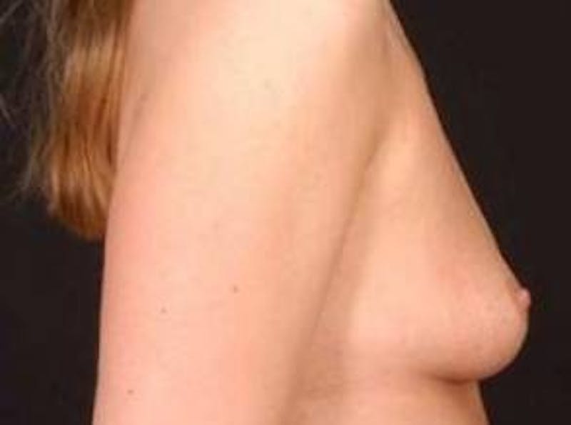 Breast Augmentation Silicone Gel Before & After Gallery - Patient 377391 - Image 5