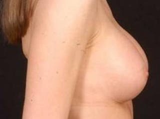 Breast Augmentation Silicone Gel Before & After Gallery - Patient 377391 - Image 6
