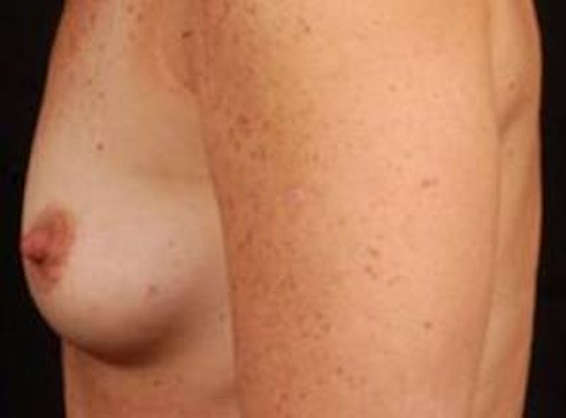 Breast Augmentation Silicone Gel Before & After Gallery - Patient 476345 - Image 3
