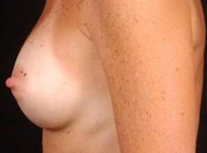 Breast Augmentation Silicone Gel Before & After Gallery - Patient 476345 - Image 4